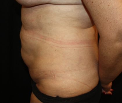 Tummy Tuck Before & After Patient #22992