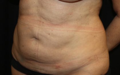 Tummy Tuck Before & After Patient #22992