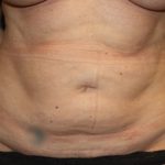 Tummy Tuck Before & After Patient #22992