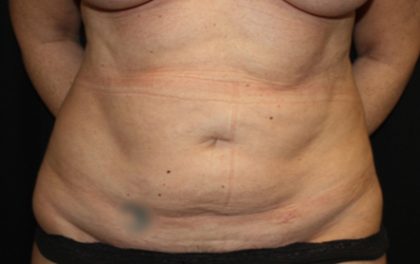 Tummy Tuck Before & After Patient #22992