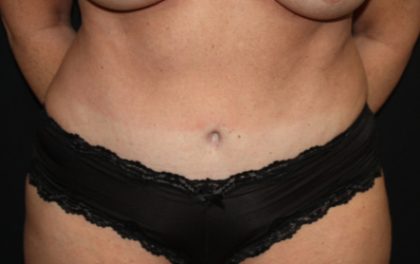 Tummy Tuck Before & After Patient #22992