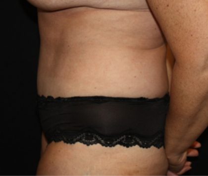 Tummy Tuck Before & After Patient #22992