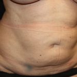 Tummy Tuck Before & After Patient #22992