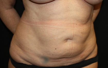 Tummy Tuck Before & After Patient #22992