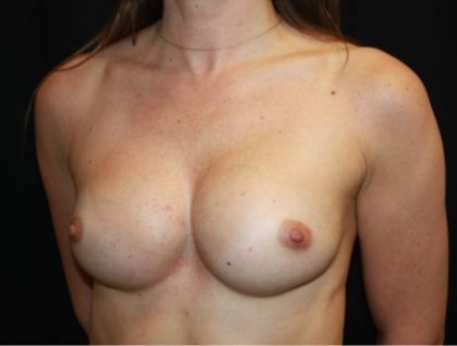 Breast Implant Exchange Before & After Patient #20721