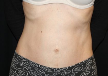 Tummy Tuck Before & After Patient #23003