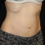 Tummy Tuck Before & After Patient #23003