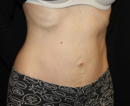 Tummy Tuck Before & After Patient #23003