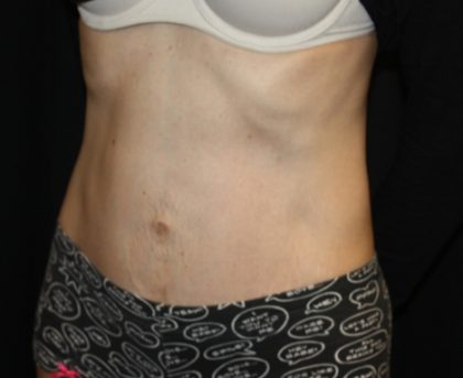 Tummy Tuck Before & After Patient #23003