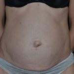 Tummy Tuck Before & After Patient #23003