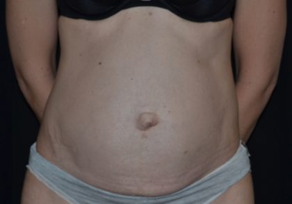 Tummy Tuck Before & After Patient #23003