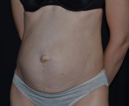 Tummy Tuck Before & After Patient #23003