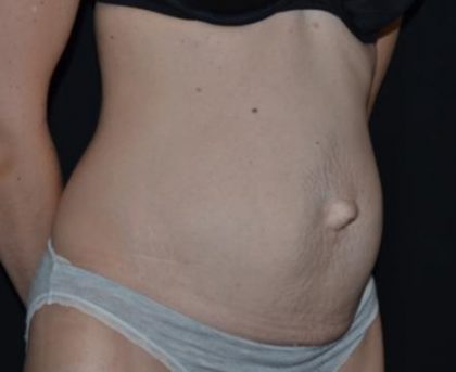 Tummy Tuck Before & After Patient #23003