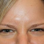 Botox and Dysport Before & After Patient #24758