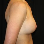 Breast Implant Exchange Before & After Patient #20676