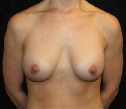 Breast Implant Exchange Before & After Patient #20676