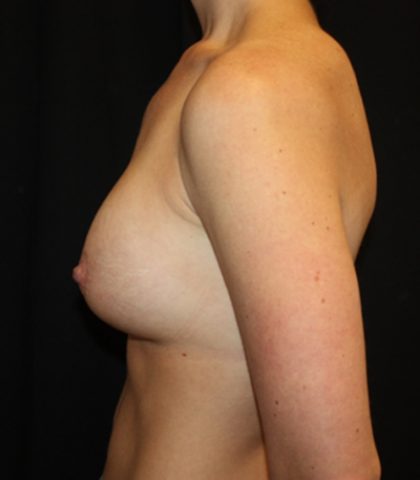 Breast Implant Exchange Before & After Patient #20676