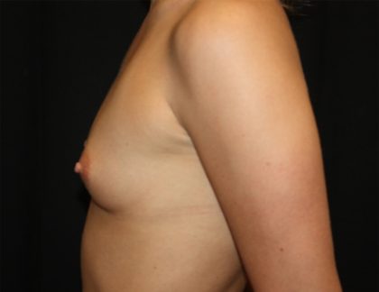 Breast Augmentation - Round Silicone Implants Before & After Patient #20410