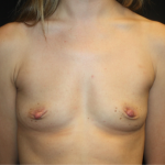 Breast Augmentation - Shaped Silicone Implants Before & After Patient #20452