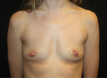 Breast Augmentation - Shaped Silicone Implants Before & After Patient #20452