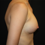 Breast Augmentation - Shaped Silicone Implants Before & After Patient #20452