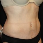 Tummy Tuck Before & After Patient #22526