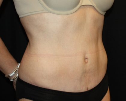 Tummy Tuck Before & After Patient #22526