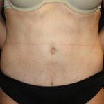 Tummy Tuck Before & After Patient #22526