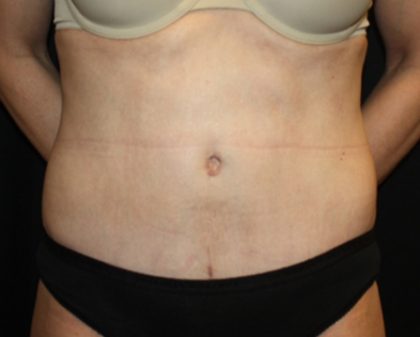 Tummy Tuck Before & After Patient #22526