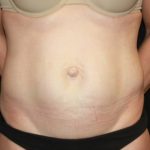 Tummy Tuck Before & After Patient #22526