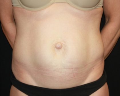 Tummy Tuck Before & After Patient #22526