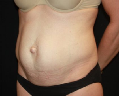 Tummy Tuck Before & After Patient #22526