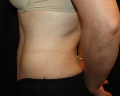 Tummy Tuck Before & After Patient #22526