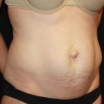 Tummy Tuck Before & After Patient #22526