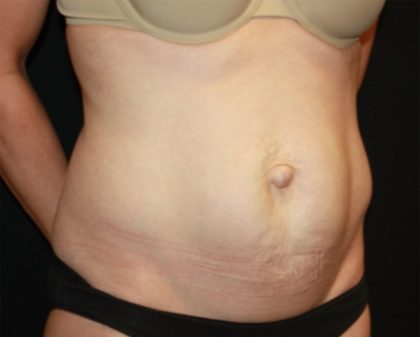 Tummy Tuck Before & After Patient #22526