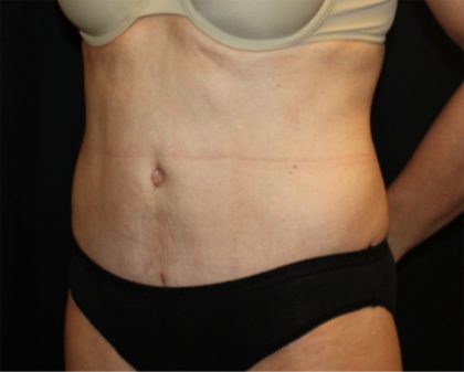 Tummy Tuck Before & After Patient #22526