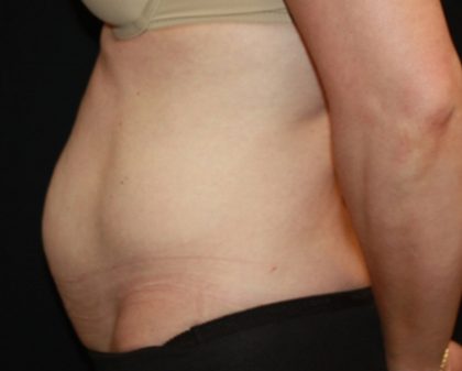 Tummy Tuck Before & After Patient #22526