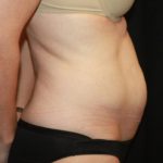 Tummy Tuck Before & After Patient #22526