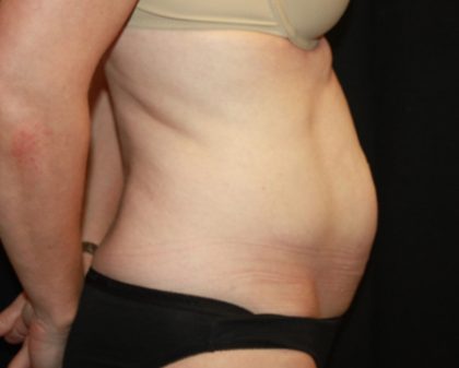 Tummy Tuck Before & After Patient #22526