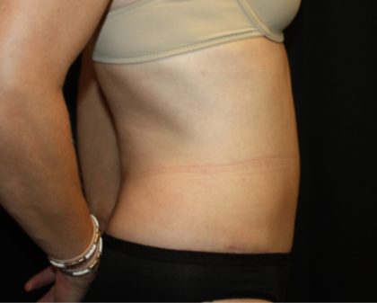 Tummy Tuck Before & After Patient #22526