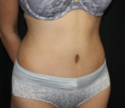 Tummy Tuck Before & After Patient #22553