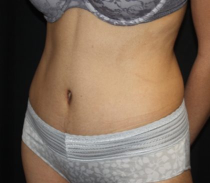 Tummy Tuck Before & After Patient #22553