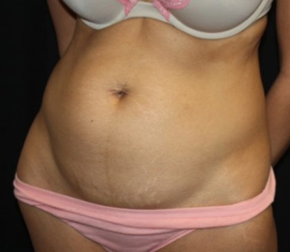 Tummy Tuck Before & After Patient #22553