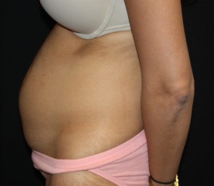 Tummy Tuck Before & After Patient #22553