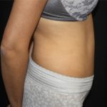 Tummy Tuck Before & After Patient #22553