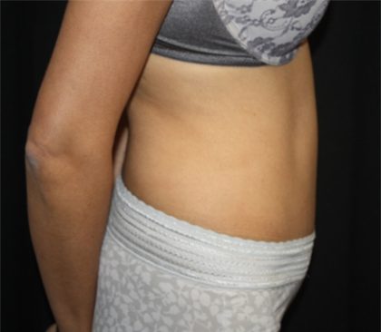 Tummy Tuck Before & After Patient #22553