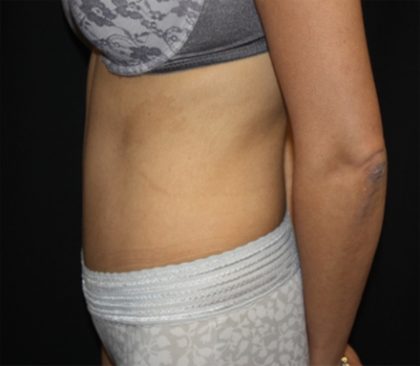 Tummy Tuck Before & After Patient #22553