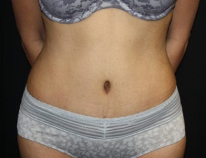 Tummy Tuck Before & After Patient #22553