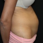 Tummy Tuck Before & After Patient #22553