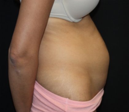 Tummy Tuck Before & After Patient #22553